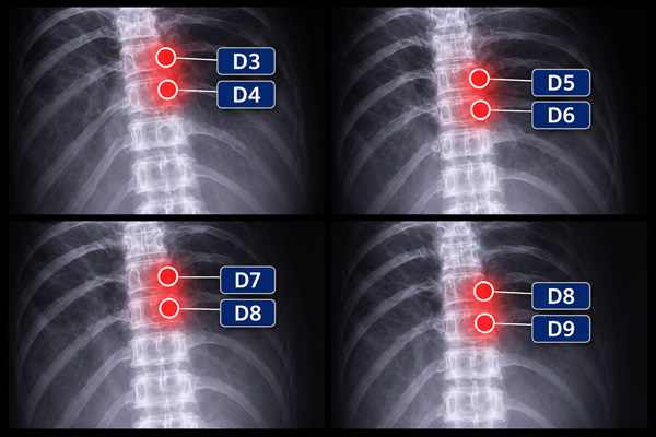 incapacidad por hernia discal dorsal
